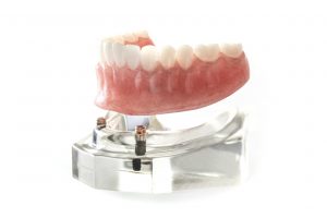 Implant-retained denture