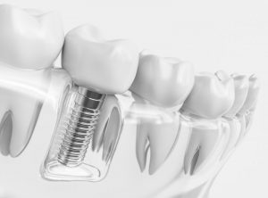 a dental implant