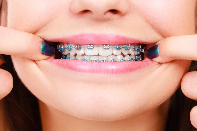 woman’s braces in Coatesville