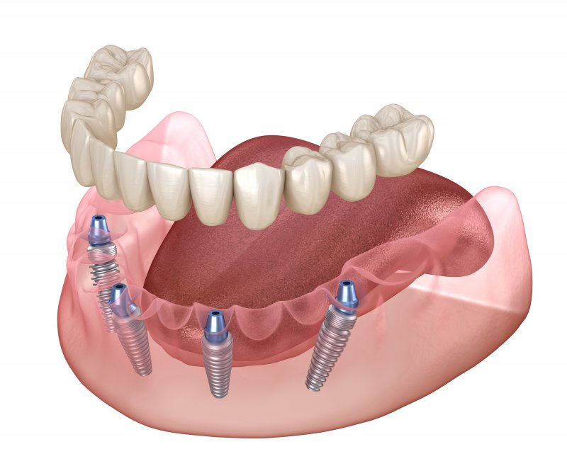 All-on-4 implants