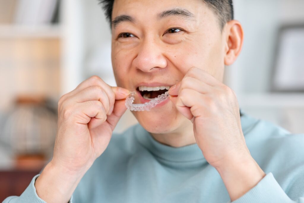 Man smiling while putting clear aligners on top teeth