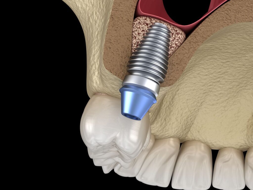 A computer-generated model of a sinus lift procedure