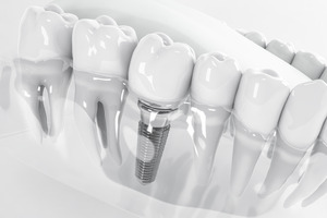 Illustration of dental implant in plastic model of mouth with other teeth