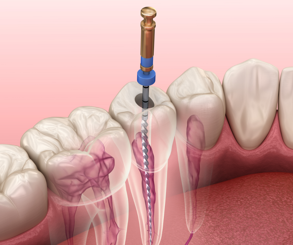 Illustrated cross section of a root canal