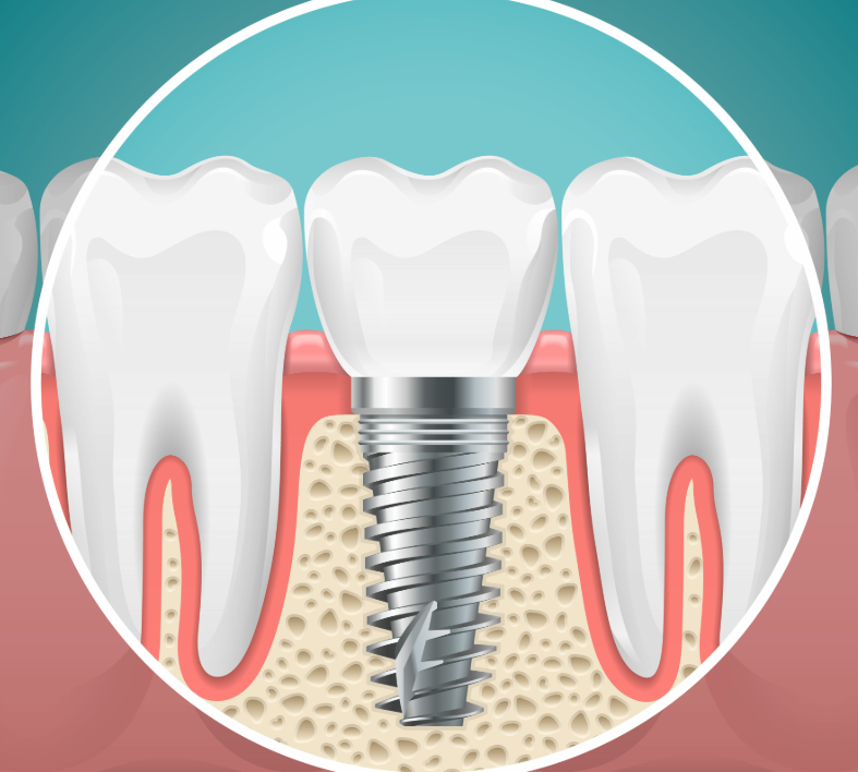 Illustrated cross section of a dental implant